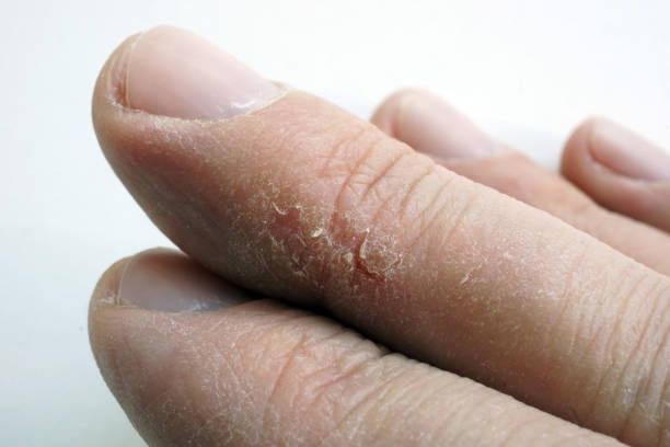 istock Dry cracked skin on fingers. Arms with dermatology problems. 1131847836