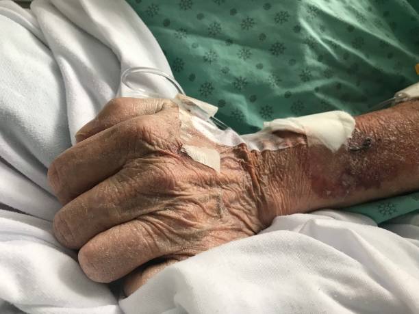 nahaufnahme der hand eines älteren mannes, während er intravenös medikamente erhält, wird allgemein iv genannt. - iv bruise stock-fotos und bilder