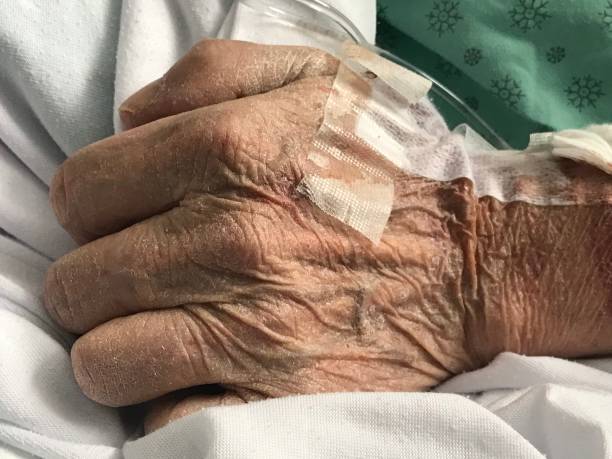 nahaufnahme der hand eines älteren mannes, während er intravenös medikamente erhält, wird allgemein iv genannt. - iv bruise stock-fotos und bilder