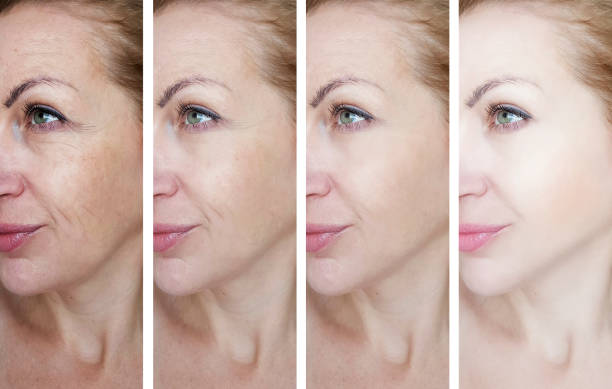 arrugas del ojo femenino antes y después de los tratamientos - wrinkle treatment fotografías e imágenes de stock