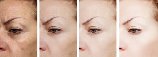istock female eye wrinkles before and after treatments 1132036764
