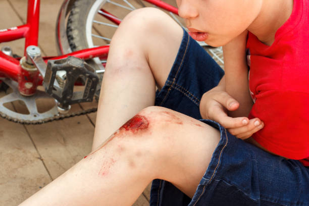 Broken wounded knee child. European boy in red T-shirt and denim shorts fell off bike and looks at wound abrasion. Children's summer holidays Broken wounded knee child. European boy in red T-shirt and denim shorts fell off bike and looks at wound abrasion. Children's summer holidays. knee contusion bruised knee stock pictures, royalty-free photos & images