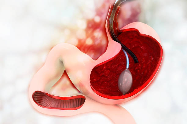 istock stomach Endoscopy. Gastric Ballon Inside a Stomach 1132244149