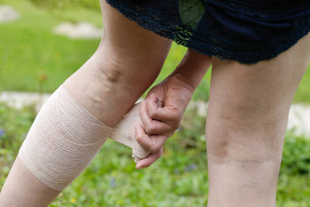 istock Woman with varicose veins applying compression bandage 1132249582