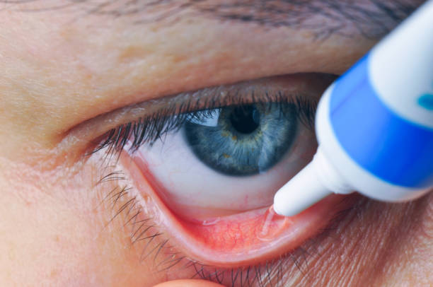 Instill eyedrops or ointment on eye.
