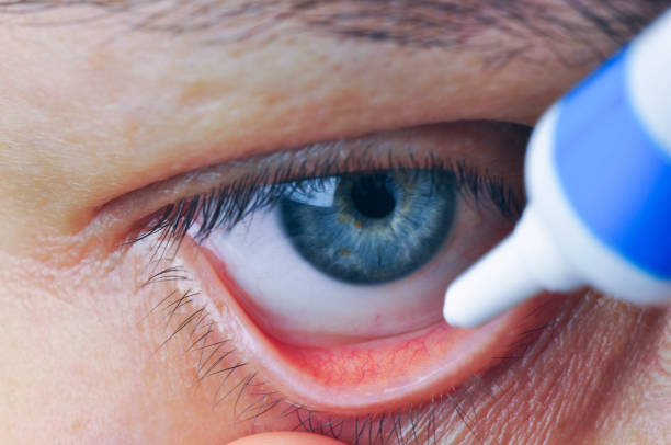 istock Instill eyedrops or ointment on eye. 1132281612