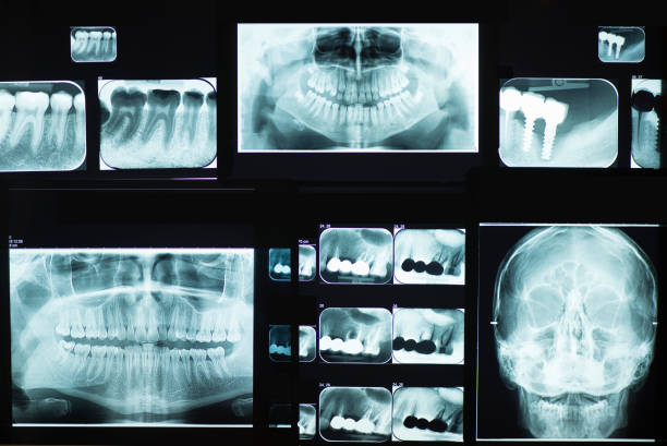 immagini a raggi x dentali - human lung x ray image x ray human spine foto e immagini stock