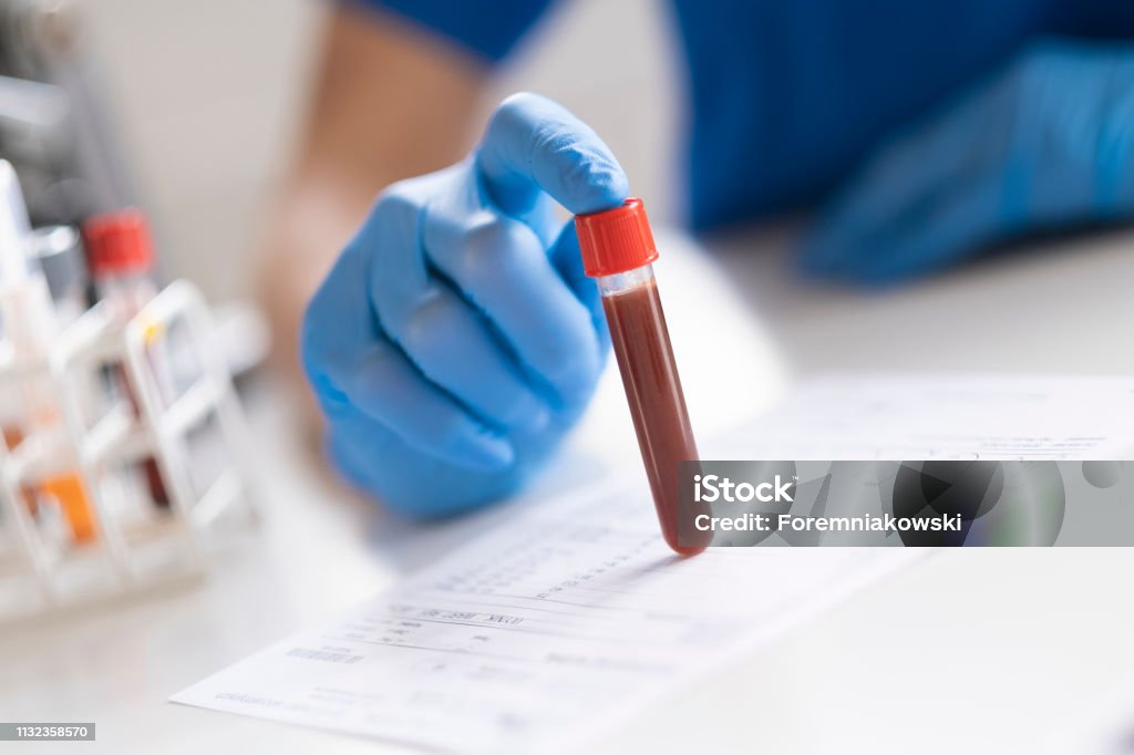 Diagnostician is doing a blood sample test. Diagnostician is holding in hand a blood sample. Blood Test Stock Photo