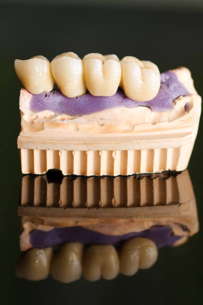 Dental bridge made of porcelain on casting  tehnical stock pictures, royalty-free photos & images