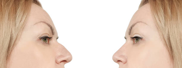 istock female nose hump before and after procedures 1132549403