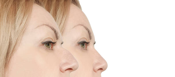 istock female nose hump before and after procedures 1132561804