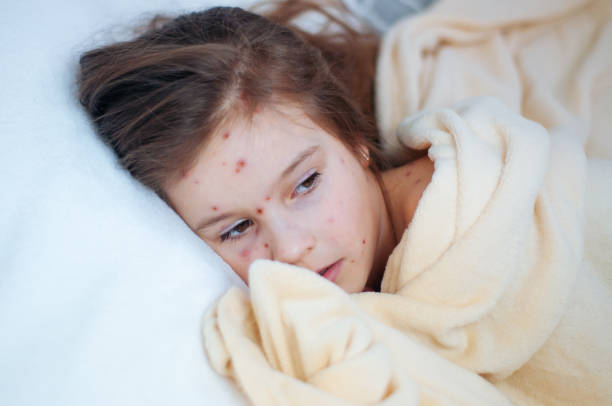 primo posto di carina bambina triste a letto. eruzione cutanea da virus varicella o bolla di varicella su bambino - chickenpox skin condition baby illness foto e immagini stock