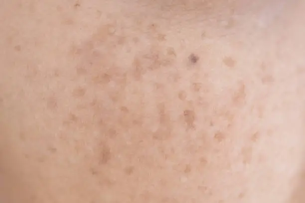 freckle on asian woman face and skin