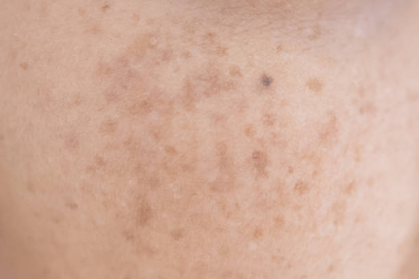 freckle na pele asiática da mulher - sarda - fotografias e filmes do acervo