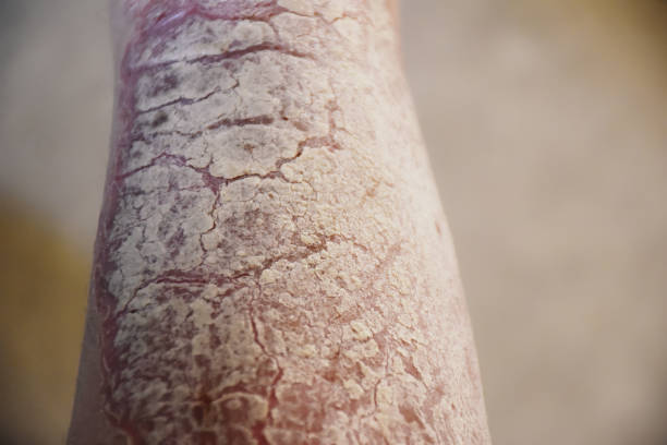 Dermatological skin disease, psoriasis is an autoimmune disease that affects the skin. Skin inflammation red and scaly also white pearl like plaques. atherosclerosis stock pictures, royalty-free photos & images