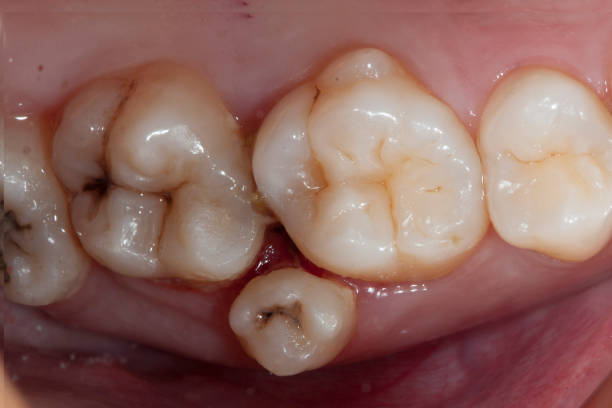過剰歯 ストックフォト