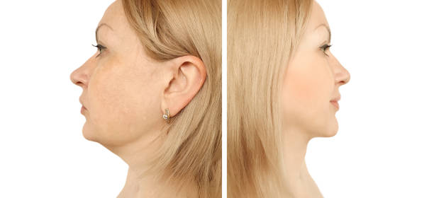istock woman double chin lift before and after procedures 1133034146