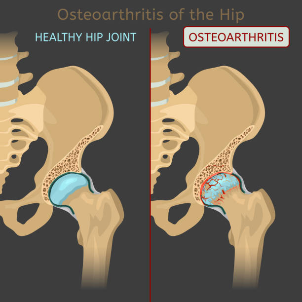 hip osteoarthritis obraz - biodro stock illustrations