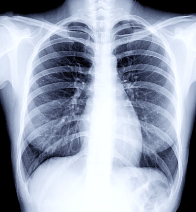 Imagen radiográfica o radiografía de tórax humano para un diagnóstico médico. concepto de comprobación. photo