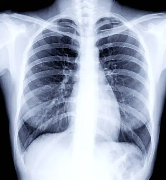 Radiographic image or X-Ray Image of Human Chest for a medical diagnosis . check up concept.