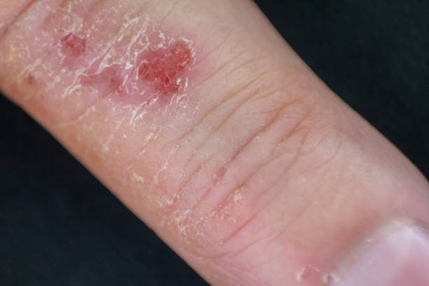 handdermatitis. finger eczema - toxicodermatitis stock-fotos und bilder