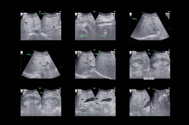 ultrasonography or ultrasound upper abdomen showing anatomic of upper abdomen , liver ,kidney, pancreas and gall bladder. - human upper body xray imagens e fotografias de stock