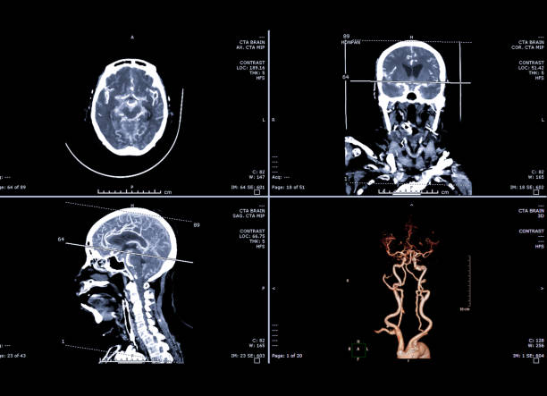 angiotomografia ou cta cérebro 3d rendering imagem, coronal, sagital e plano axial para encontrar acidente vascular cerebral e doença do aneurisma. - computed - fotografias e filmes do acervo