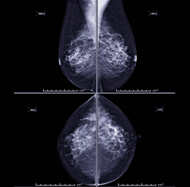 istock X-ray Digital Mammogram both side CC view and MLO . mammography or breast scan for Breast cancer showing  a benign calcification in right breast without evidence of malignancy ( BIRADS3 ). 1133323363