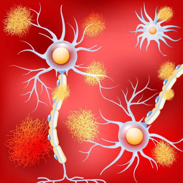 bildbanksillustrationer, clip art samt tecknat material och ikoner med neuroner i hjärnan med alzheimers sjukdom, och amyloid plack. - amyloid