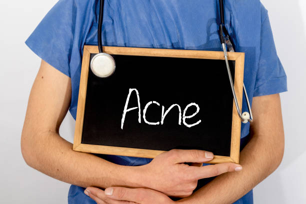 istock Doctor shows information on blackboard: acne.  Medical concept. 1133462589