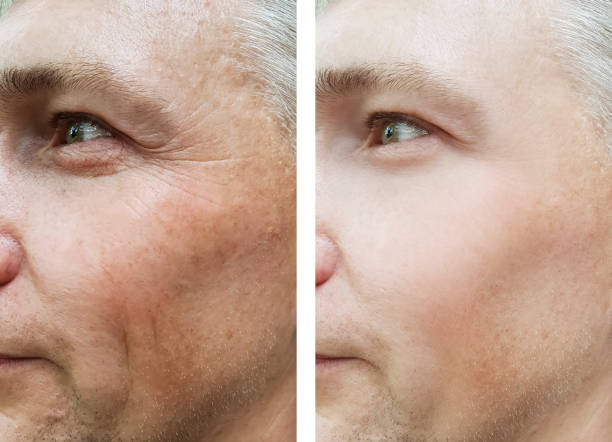 male face wrinkles before and after treatments male face wrinkles before and after treatments botox before and after stock pictures, royalty-free photos & images