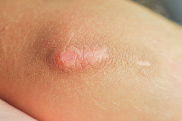 Scar on elbow of the child. Concept of negligence doctor.