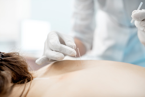 Close-up of the acupuncture medical treatment with special needles