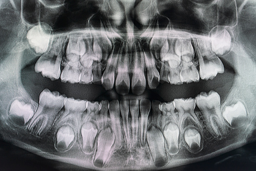 Dental X-Ray