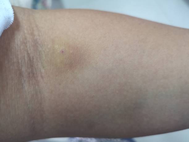 istock Contosion after syringe give blood on hand 1133936426