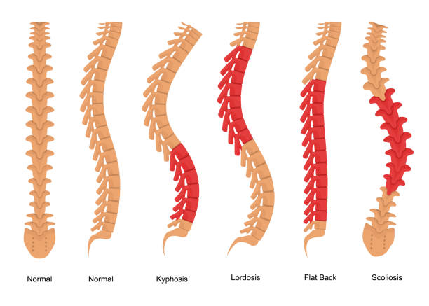 illustrazioni stock, clip art, cartoni animati e icone di tendenza di poster della scheda concettuale per i tipi ossei dell'osteoporosi. vettore - scoliosis