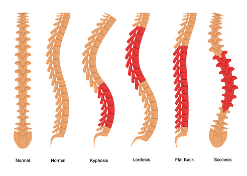 Osteoporosis Bone Types Infographics Concept Card Poster Include of Scoliosis, Kyphosis, Lordosis and Normal. Vector illustration of Backbone