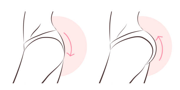 illustrations, cliparts, dessins animés et icônes de femme de beauté avec l'implant de crosse - human muscle buttocks sport surgery