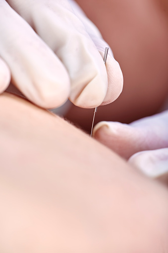 Chiropractor doing dry needling, closeup of a needle and hands. Physiotherapist, osteopath, manual therapy, acupressure. Acupuncture, alternative medicine.