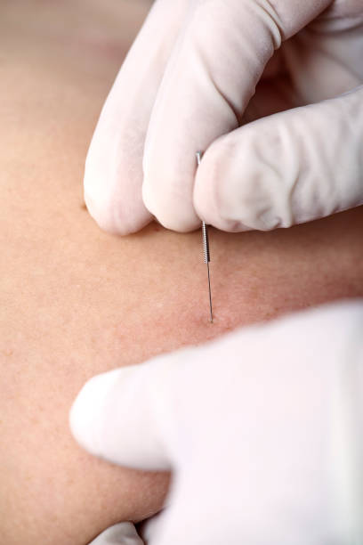 istock Chiropractor doing dry needling, closeup of a needle and hands. Physiotherapist, osteopath, manual therapy, acupressure. Acupuncture, alternative medicine. 1134444233