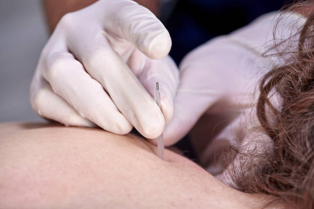 istock Chiropractor doing dry needling, closeup of a needle and hands. Physiotherapist, osteopath, manual therapy, acupressure. Acupuncture, alternative medicine. 1134444392