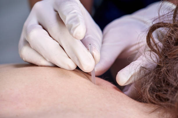 istock Chiropractor doing dry needling, closeup of a needle and hands. Physiotherapist, osteopath, manual therapy, acupressure. Acupuncture, alternative medicine. 1134447569