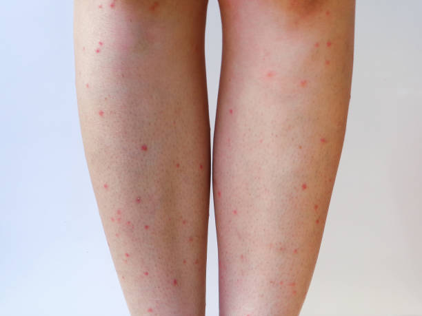 placere vil gøre Nuværende Legs With Many Red Spot And Scar From Mosquitos Bites Mosquitos Allergy  Stock Photo - Download Image Now - iStock