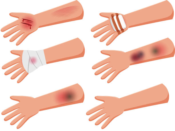 Set of injury arms Set of injury arms illustration bruise stock illustrations