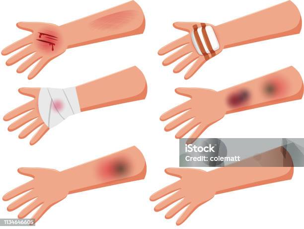 Set Of Injury Arms Stock Illustration - Download Image Now - Bruise, Hand, Arm