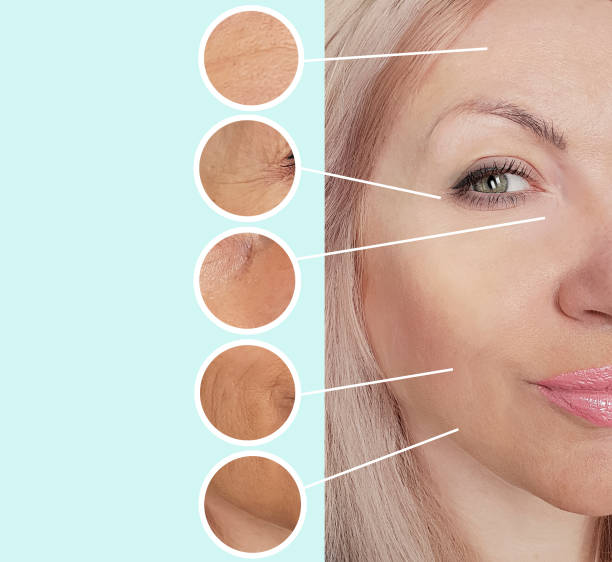 istock woman wrinkles face before and after procedures collage 1134734701