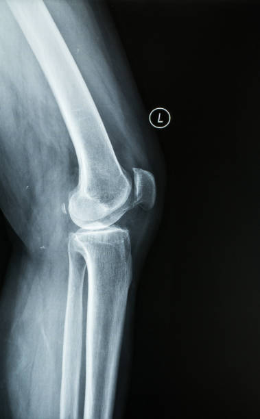 人間の足の接合箇所、膝の x 線のフィルム - cartilage patella human knee medical exam ストックフォトと画像