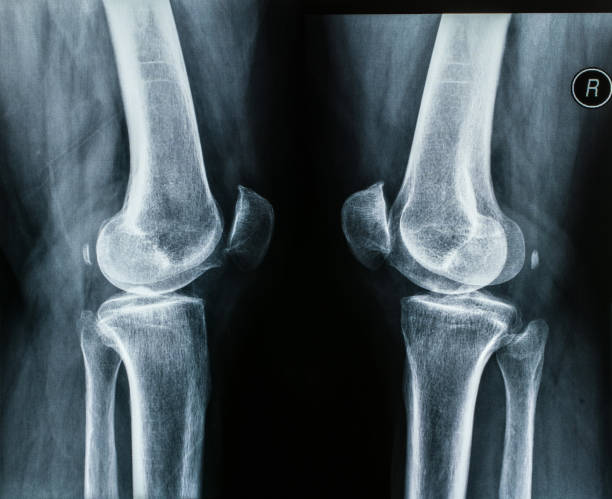 articulations de jambe humaines, films de radiographie de genou - humerus photos et images de collection