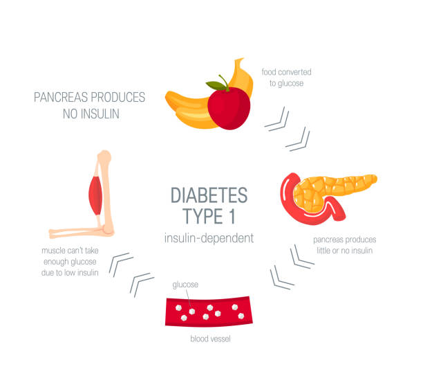 illustrazioni stock, clip art, cartoni animati e icone di tendenza di concetto di diabete di tipo 1 in stile piatto, vettore - insulin resistance