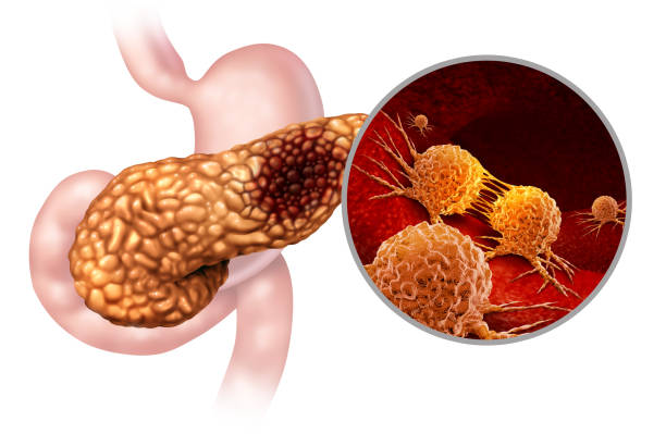 istock Pancreatic Cancer Anatomy 1135033872